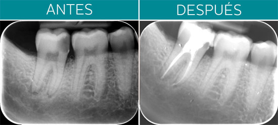 Zamora Centro Odontológico. Endodoncia