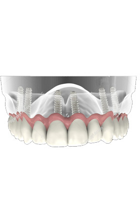 Implantes fijos. Zamora Centro Odontológico. Clínica dental Almería