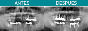 Caso clínco. Odontología restauradora. Zamora Centro Odontológico