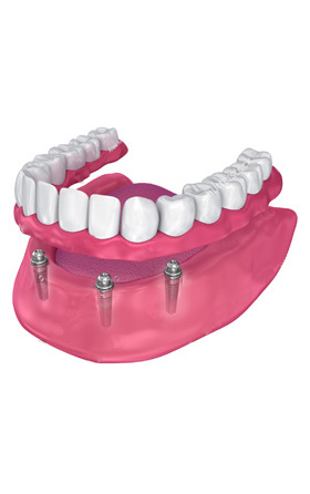 Implantes semi-fijos. Zamora Centro Odontológico. Clínica Dental Almería