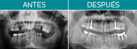 Caso clínco. Odontología restauradora. Zamora Centro Odontológico